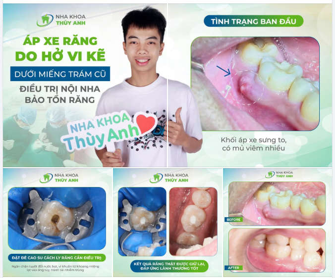 ÁP XE RĂNG 46 DO HỞ VI KẼ DƯỚI MIẾNG TRÁM CŨ – ĐIỀU TRỊ NỘI NHA BẢO TỒN RĂNG