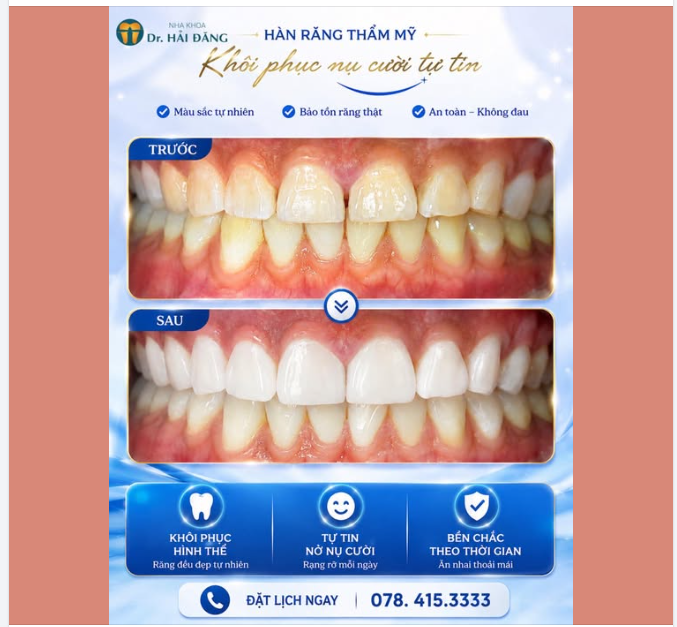 HÀN KẼ RĂNG THẨM MỸ – NHẸ NHÀNG THAY ĐỔI - TỰ TIN NỤ CƯỜI