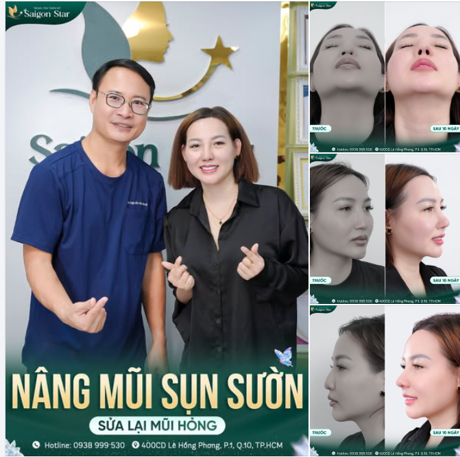 CÙNG DR. HOẠT SỬA DÁNG MŨI - LẤY LẠI TỰ TIN SAU 4 LẦN NÂNG MŨI HỎNG