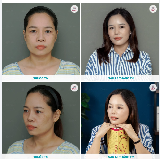 Phương pháp làm đẹp phù hợp giúp khuôn mặt trở nên mềm mại, hài hòa hơn nhưng vẫn giữ được nét tự nhiên