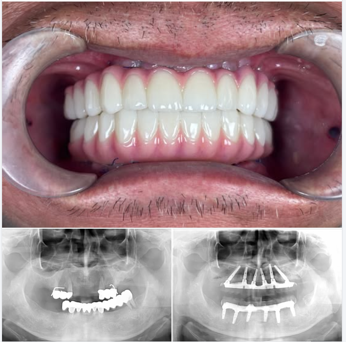 CẮM IMPLANT – 3 NGÀY ĐÃ CÓ RĂNG ĂN NHAI???