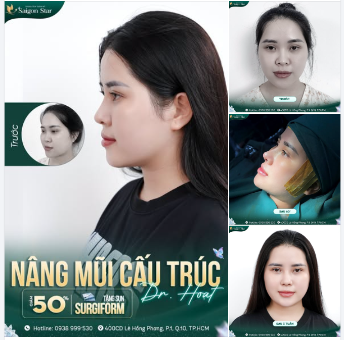 MŨI NHIỀU KHUYẾT ĐIỂM? 60 PHÚT ĐẢO NGƯỢC TÌNH THẾ