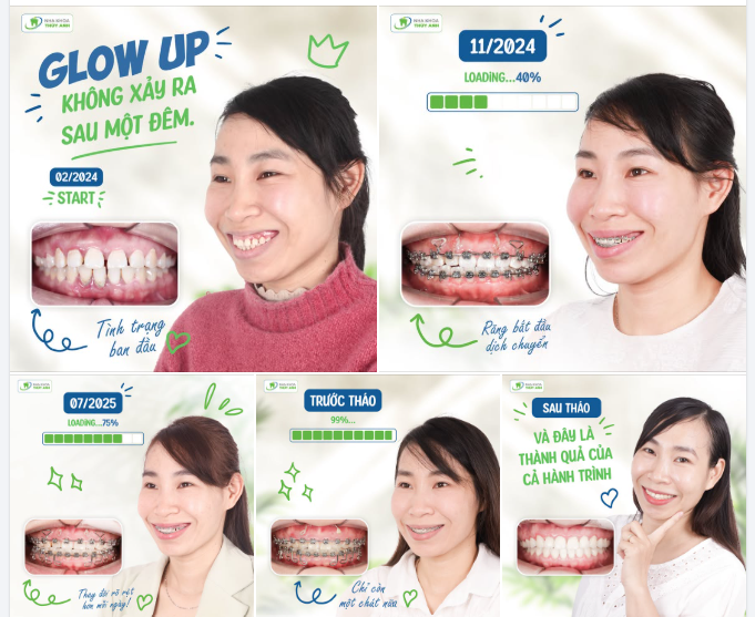 KHI NHỮNG KHOẢNG THƯA DẦN BIẾN MẤT, NỤ CƯỜI CŨNG THAY ĐỔI