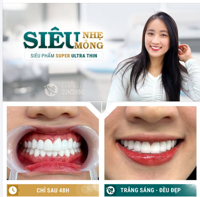 ĐÃ BAO LÂU RỒI BẠN CHƯA THỰC SỰ SỞ HỮU MỘT NỤ CƯỜI RẠNG RỠ VÀ TỰ TIN NHẤT?" 