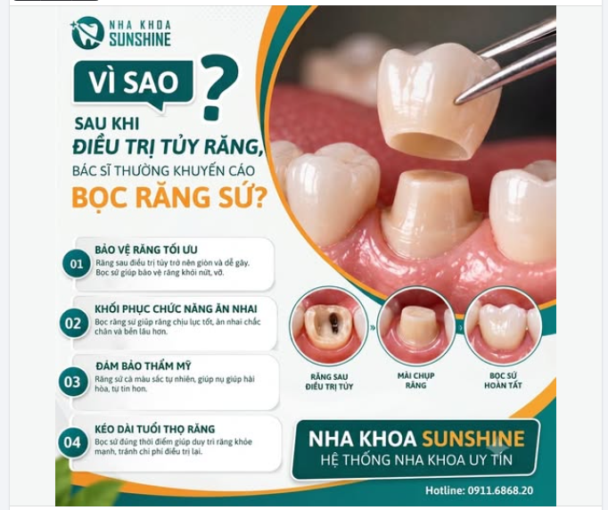 "ĐIỀU TRỊ TỦY XONG MÀ KHÔNG BỌC SỨ — BẠN ĐANG MẠO HIỂM MẤT LUÔN CHIẾC RĂNG THẬT!"