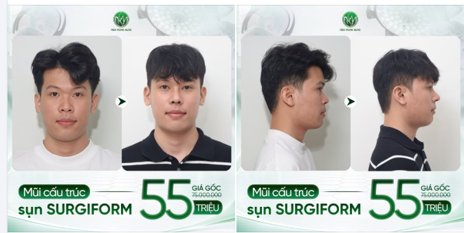 Muốn nâng mũi nam nhưng chưa biết mình hợp dáng nào?
