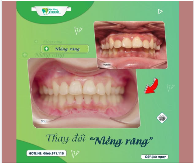 Những ai không nên niềng răng?