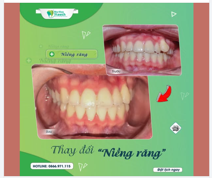 Vệ sinh răng khi đang niềng sao cho đúng?