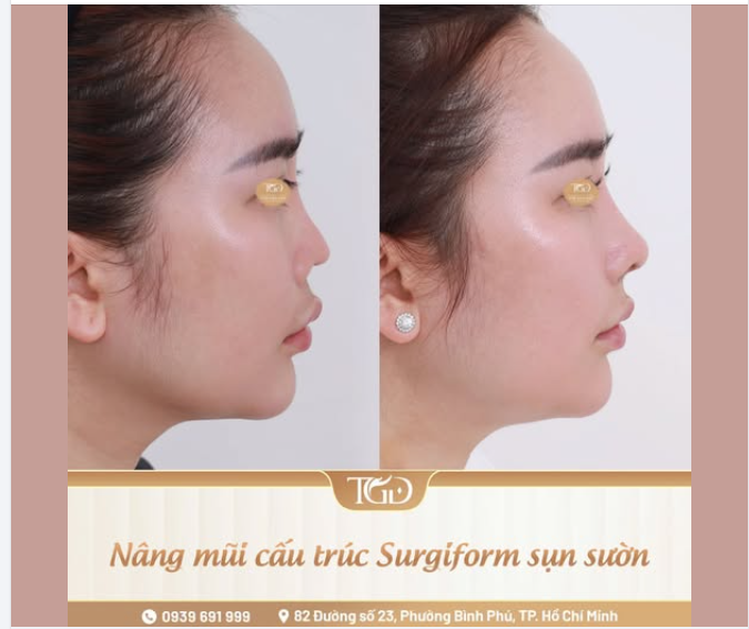 Tái sinh dung nhan từ nền mũi phức tạp sau nhiều lần phẫu thuật