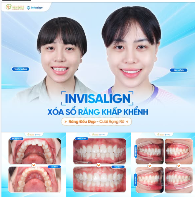 Thoải mái chỉnh nha, tự tin là chính mình cùng Invisalign