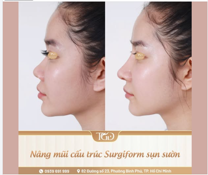 Góc nghiêng thay đổi – Dáng mũi hài hòa hơn với nâng mũi cấu trúc Surgiform sụn tự thân