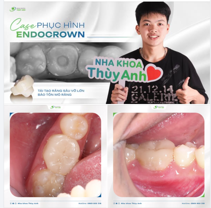 PHỤC HỒI RĂNG HÀM SÂU VỠ LỚN VỚI GIẢI PHÁP ENDOCROWN