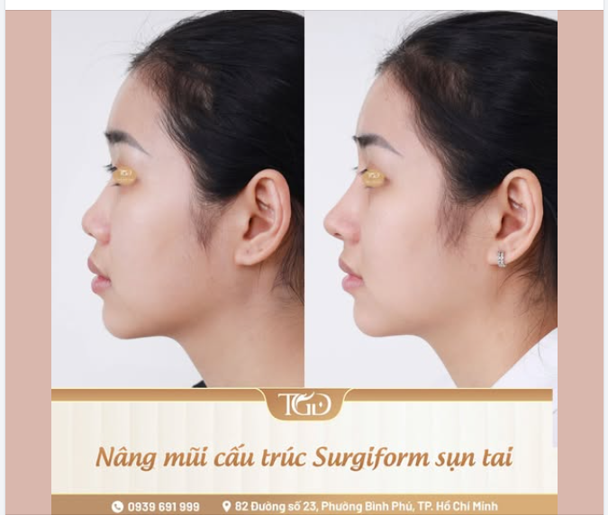 Lấy sụn tai trong nâng mũi liệu có ảnh hưởng đến hình dáng tai?