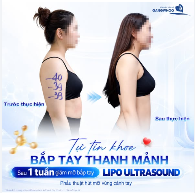 TỰ TIN KHOE BẮP TAY THANH MẢNH - SAU 1 TUẦN GIẢM MỠ BẮP TAY LIPO ULTRASOUND