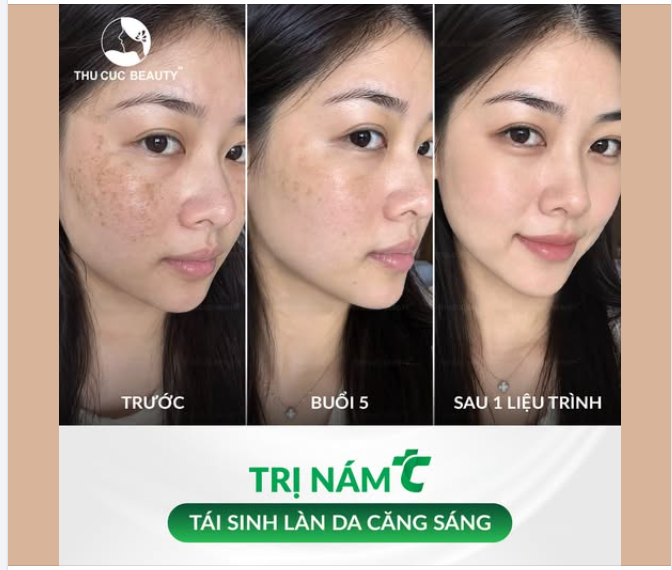 RẠNG RỠ VỚI LÀN DA KHÔNG KHUYẾT ĐIỂM CÙNG TRỊ NÁM TC TẠI THU CÚC