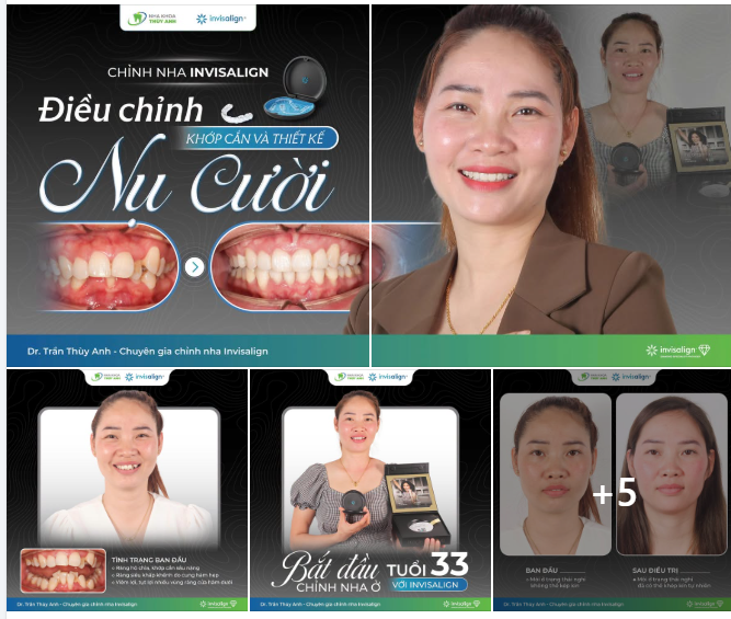 ĐIỀU TRỊ HÔ HÀM KẾT HỢP CẮN SÂU VÀ CHEN CHÚC BẰNG INVISALIGN Ở TUỔI 33