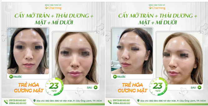 CÔNG THỨC TÌM LẠI THANH XUÂN: CẤY MỠ VI LIỀU