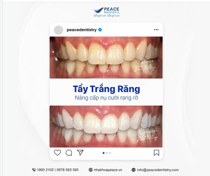 RĂNG TRẮNG SÁNG RẠNG RỠ NHANH CHÓNG - QUY TRÌNH ÊM ÁI, NHẸ NHÀNG
