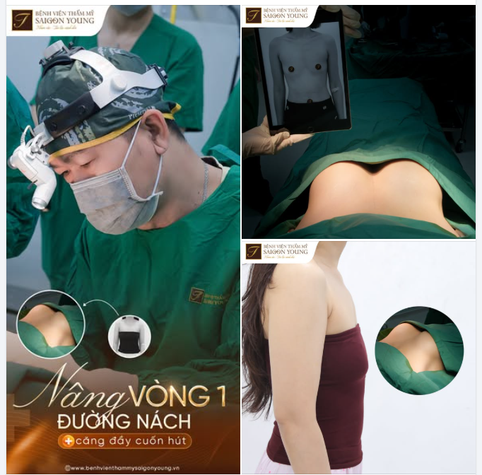 CHINH PHỤC VÒNG 1 HOÀN MỸ QUA ĐƯỜNG NÁCH BỞI BÁC SĨ TƯƠI - HƠN 25 NĂM KINH NGHIỆM
