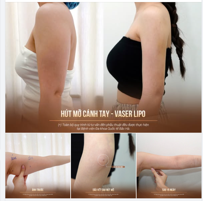 CÁNH TAY GỌN HƠN, TỔNG THỂ THÂN TRÊN THAY ĐỔI