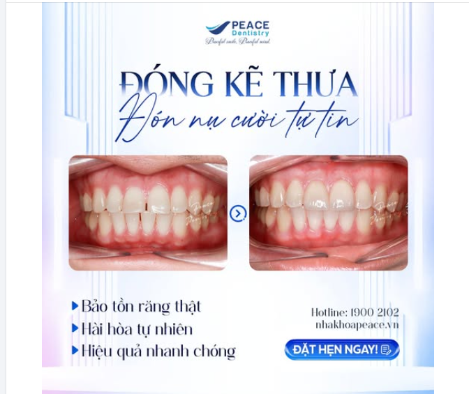 RĂNG THƯA CÓ ĐANG KHIẾN BẠN NGẠI CƯỜI? LẤY LẠI NỤ CƯỜI TỰ TIN VỚI VENEER NGAY HÔM NAY