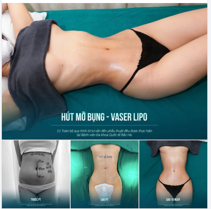 NẾU ĐANG TÌM HIỂU HÚT MỠ SIẾT EO 360, BẠN SẼ MUỐN XEM BODY NÀY