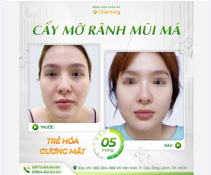 ĐỂ EM VẪN LUÔN LÀ EM BÉ - CHỌN NGAY PHƯƠNG PHÁP CẤY MỠ VI LIỀU