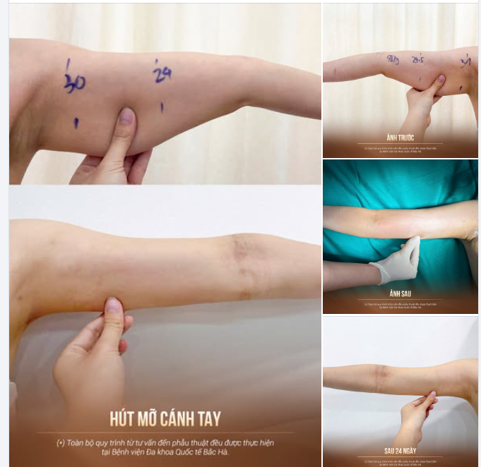 HÚT MỠ BẮP TAY – “LÊN FORM” NGAY SAU KHI THỰC HIỆN