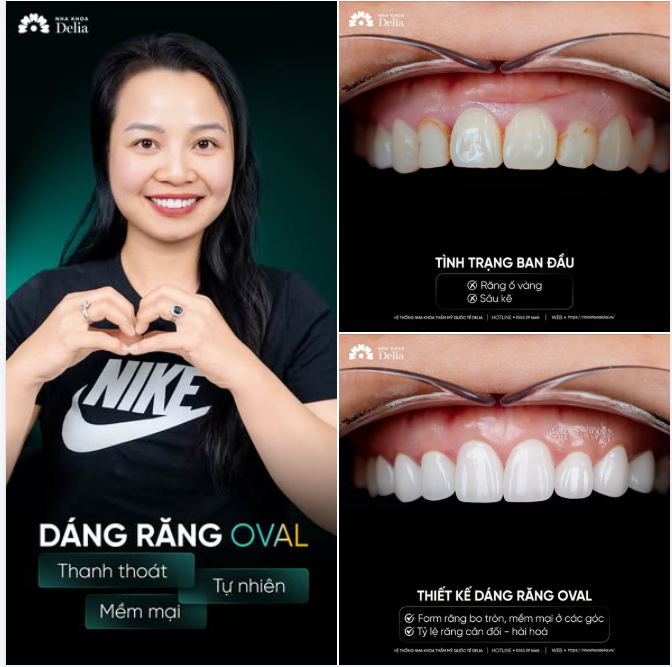 DÁNG RĂNG OVAL PHÙ HỢP CHO NHỮNG CHỊ EM NÀO?