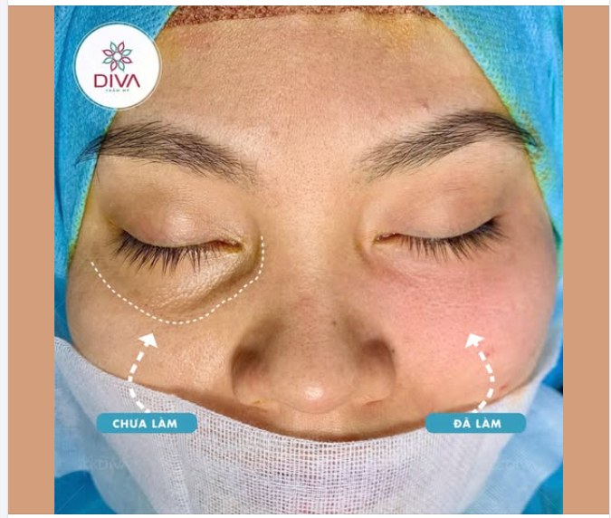 Cải thiện trũng mắt dưới ĐÚNG CÁCH như thế nào?