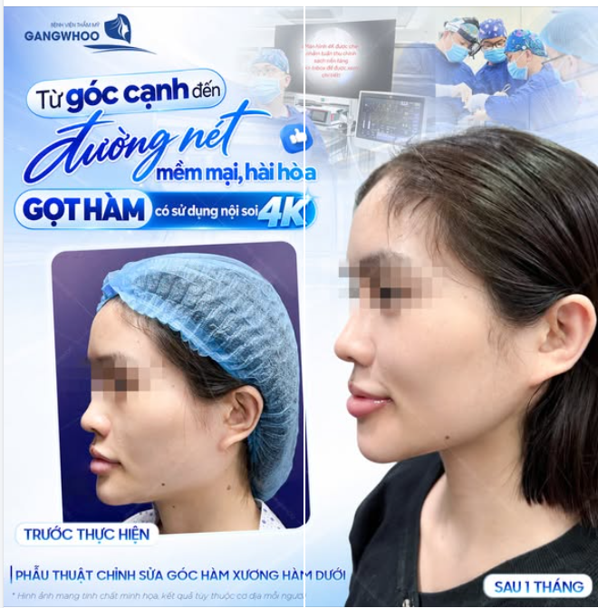TỪ GÓC CẠNH ĐẾN ĐƯỜNG NÉT MỀM MẠI, HÀI HÒA - GỌT HÀM CÓ SỬ DỤNG NỘI SOI 4K