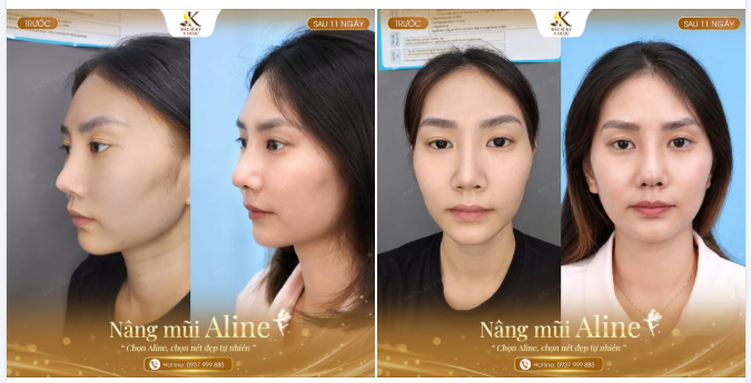 PHƯƠNG PHÁP NÂNG MŨI BẢO TỒN MÔ - CẢI THIỆN DÁNG MŨI HỎNG