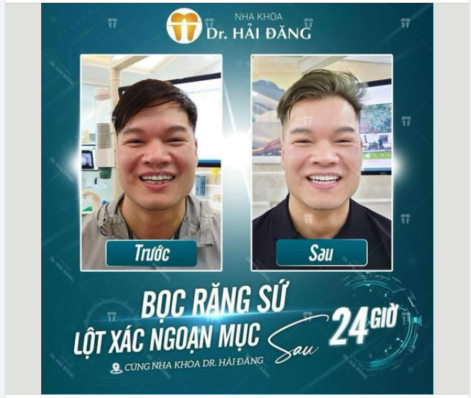 BỌC RĂNG SỨ – LỘT XÁC NGOẠN MỤC CHỈ SAU 24 GIỜ