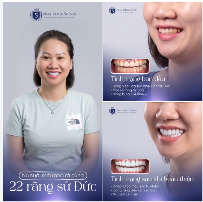 Sau nhiều lần sửa răng tại Đức, chị Ngọc quyết định về Việt Nam làm lại nụ cười.