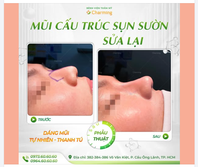 POV: ĐÂY LÀ DÁNG MŨI CỦA BẠN SAU NÂNG MŨI TẠI CHARMING!