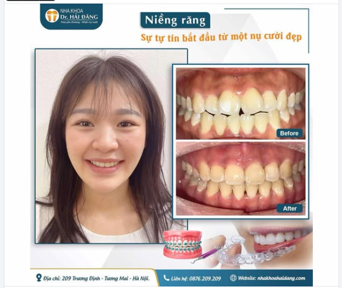 NIỀNG RĂNG – TỰ TIN TỎA SÁNG VỚI NỤ CƯỜI ĐẸP
