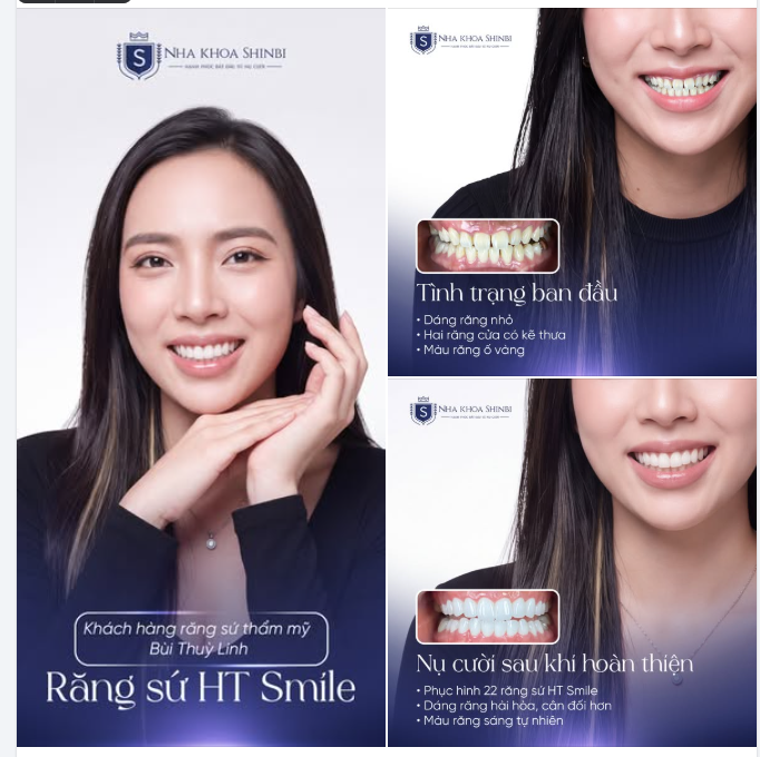Răng nhỏ, thưa, ố vàng khiến chị Linh ngần ngại suốt những năm thanh xuân