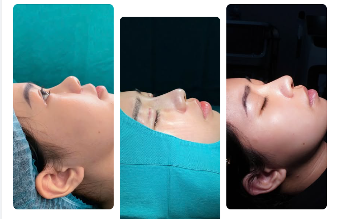 ĐỔI DÁNG MŨI, THÊM NẾP MÍ — GƯƠNG MẶT SAU 12 NGÀY CÓ GÌ KHÁC?
