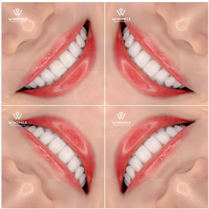 Không xâm lấn, không mài ép - Dán sứ Veneer ra đời chính là để bảo tồn trọn vẹn nền răng gốc khoẻ mạnh, khéo léo khoác lên cho nụ cười một lớp áo mới rạng rỡ và tinh tế