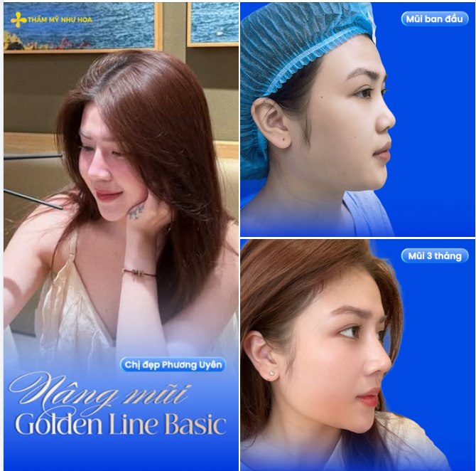 "Trộm vía, xinh lắm chị ạ" – feedback đáng yêu của chị đẹp Phương Uyên sau 3 tháng nâng mũi Golden Line Basic tại Như Hoa.