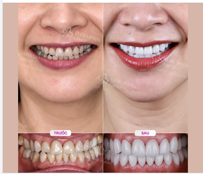 DÁN SỨ VENEER ĐỂ TỰ TIN HƠN VỚI NỤ CƯỜI RẠNG RỠ NHƯNG VẪN BẢO TỒN TỐI ĐA RĂNG THẬT