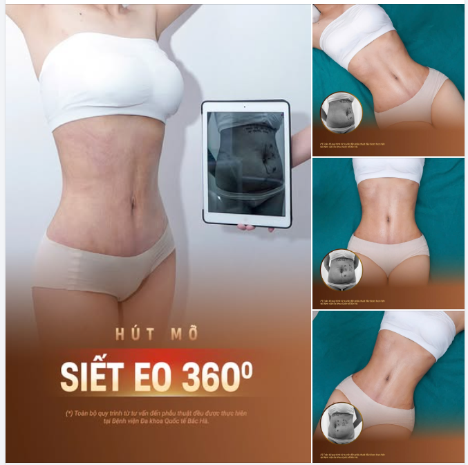 3 LO LẮNG THƯỜNG GẶP TRƯỚC KHI HÚT MỠ