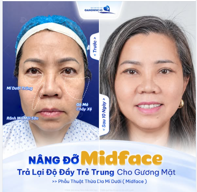 MÍ DƯỚI TRŨNG, RÃNH LỆ SÂU, GÒ MÁ XỆ
