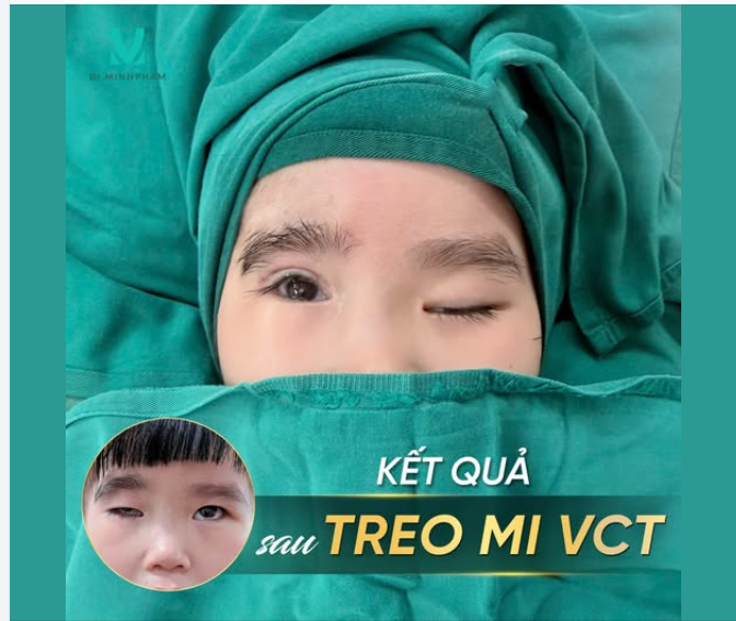 Bé Minh Châu trước khi đến với Dr. Minh Phạm có tình trạng sụp mí mắt phải độ nặng, hai bên mí mắt không cân đối khiến tầm nhìn của bé bị hạn chế