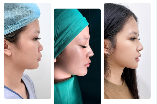 7 NGÀY – DÁNG MŨI ĐÃ BẮT ĐẦU LÊN FORM