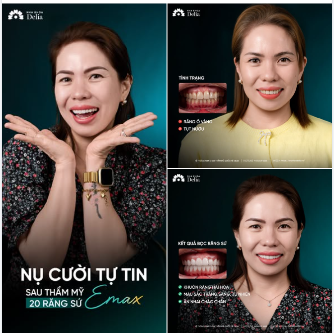 VƯỢT HÀNG NGÀN CÂY SỐ TỪ ÚC ĐẾN VIỆT NAM: BỌC 20 RĂNG SỨ EMAX LÀM MỚI NỤ CƯỜI ​