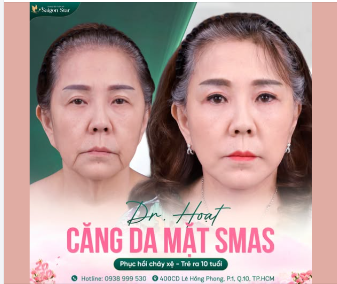 CĂNG DA MẶT SMAS CĂNG DA CHẢY XỆ - TÌM LẠI THANH XUÂN