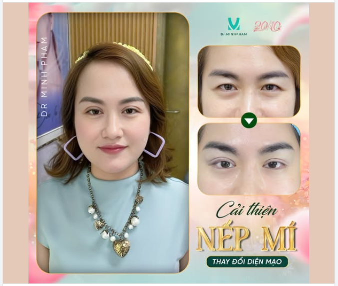 Cắt Mí – Kiến Tạo Đôi Mắt Hai Mí Tự Nhiên