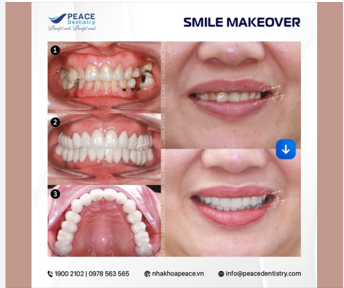 TÁI TẠO TOÀN DIỆN NỤ CƯỜI VỚI RĂNG SỨ THẨM MỸ
