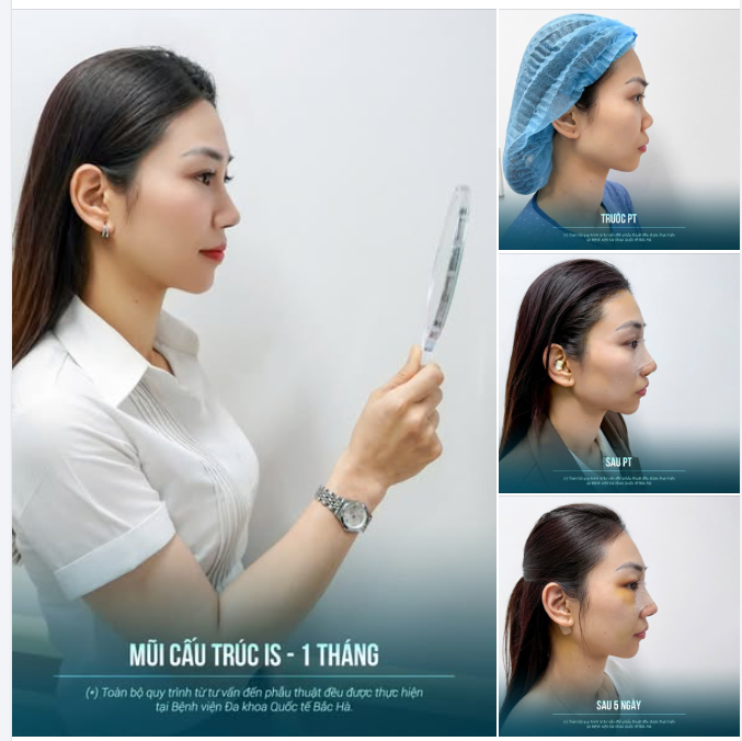 MUỐN MŨI CAO TÂY, NHƯNG SỢ LÊN DÁNG LẠI QUÁ THÔ…